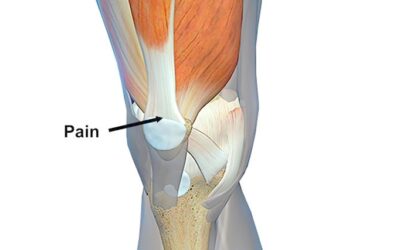 Tendinopathies Demystified